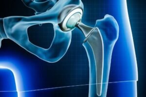 Primary Hip Replacement: A Complete Guide for Patients